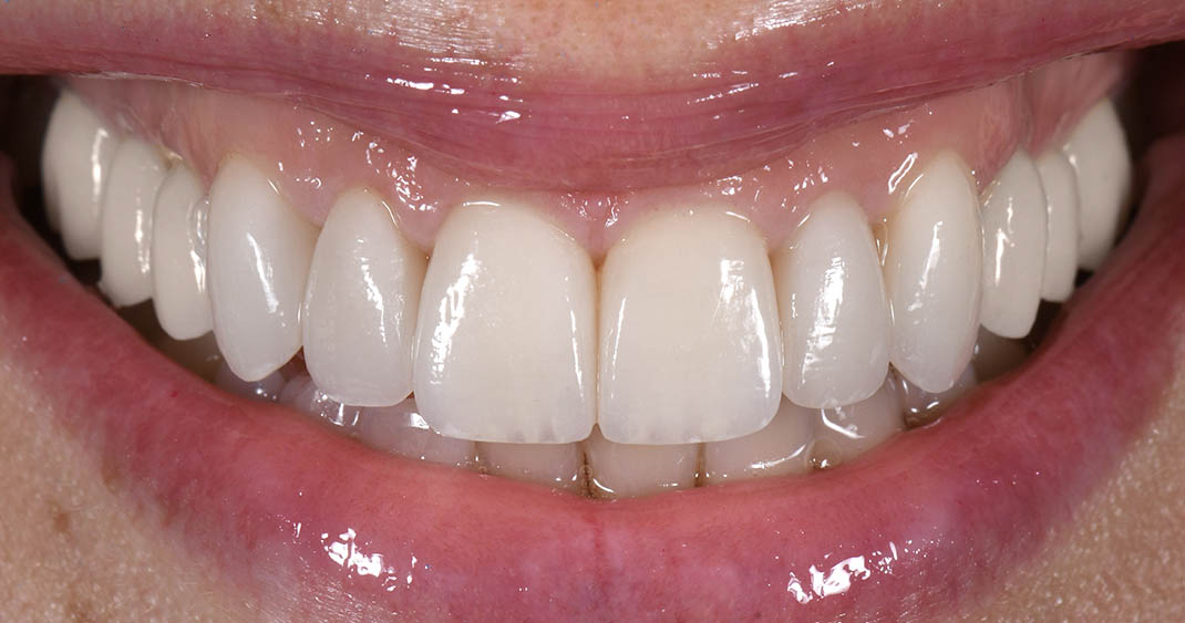 Veneers vs. Bonding: Which Is Right for Your Smile?