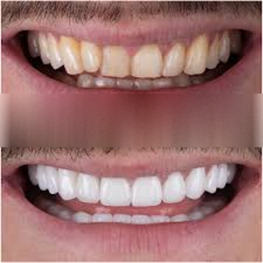 How Sugar Really Attacks Your Enamel