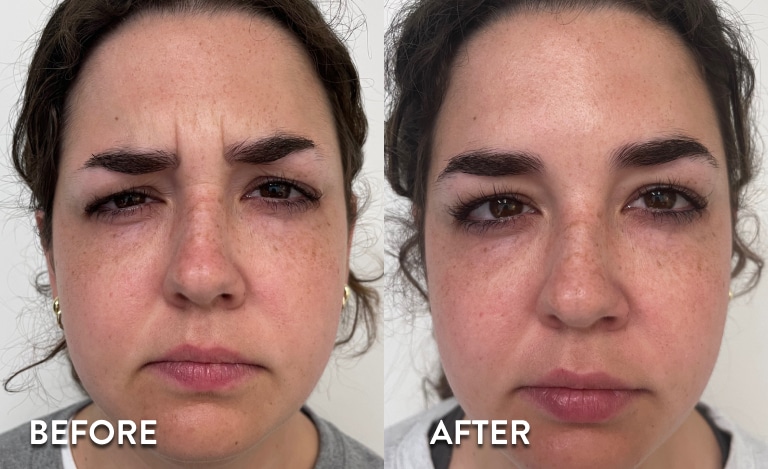 Before and after botox treatment of frown lines between the brows