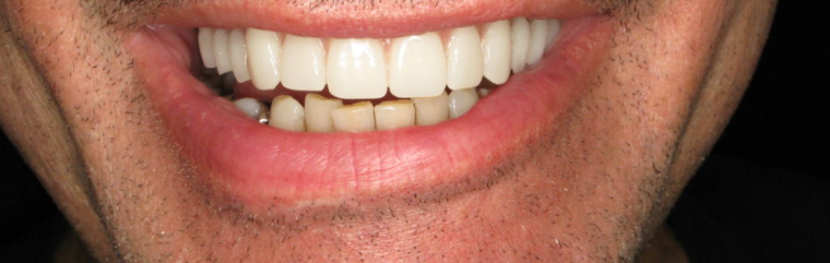 After implant treatment