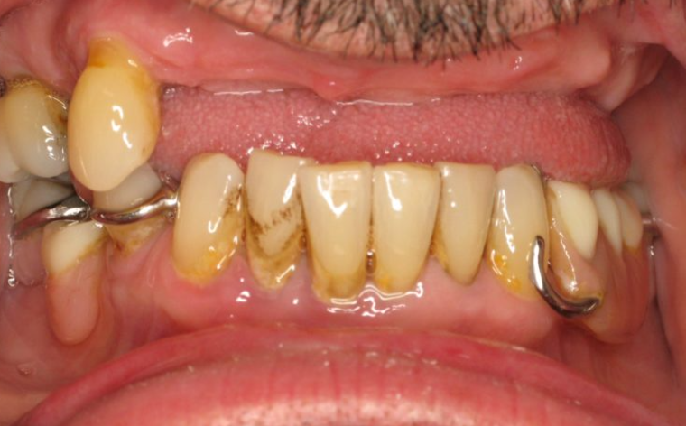 Before implant treatment
