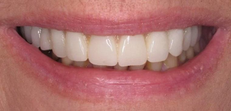 After implant treatment