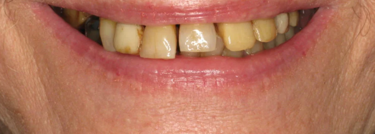 Before implant treatment