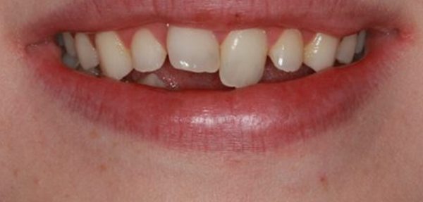 Before Invisalign treatment