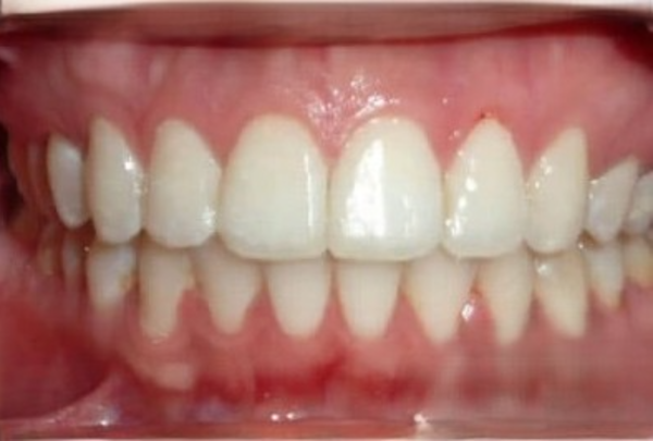 After Invisalign treatment