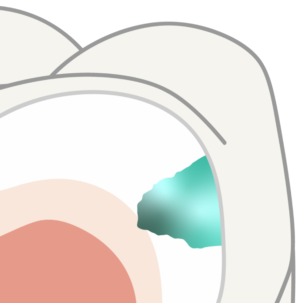 Diagram of an early enamel lesion being remineralized