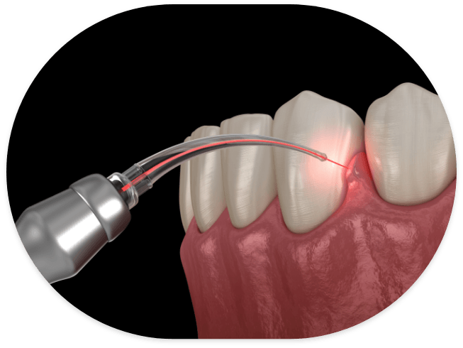 Dental laser treating tissue at the gumline