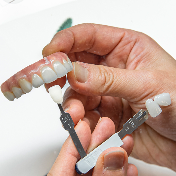 Porcelain veneers