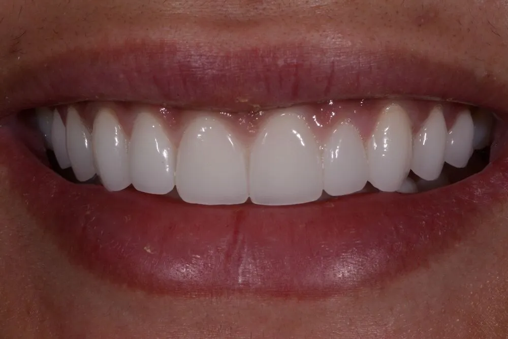 After teeth whitening