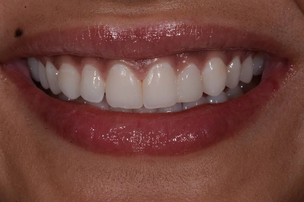 Before teeth whitening