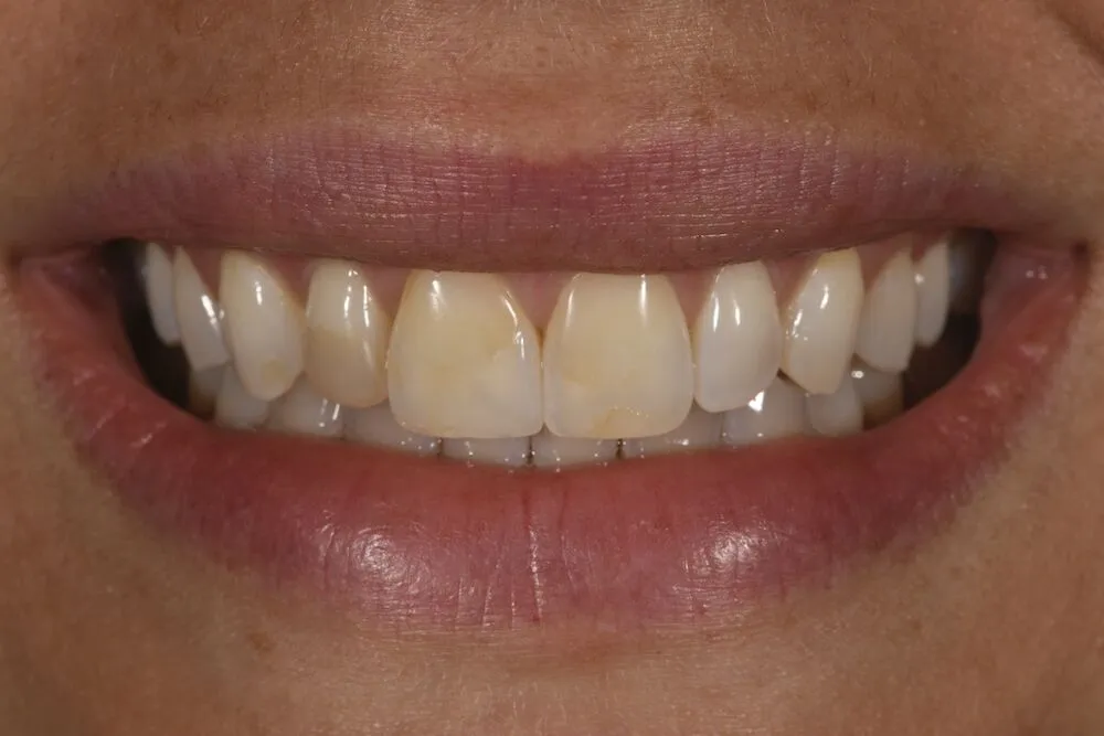 Before teeth whitening
